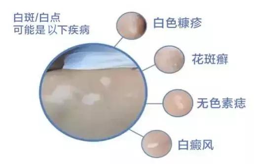 宝宝的脸上有一团团白色的东西是什么