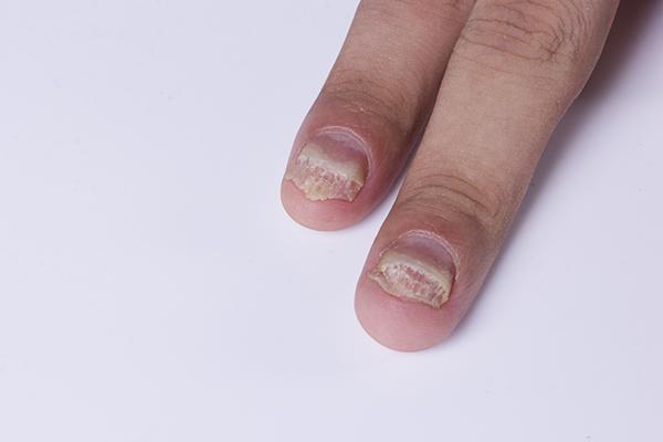 得了灰指甲一定要拔掉指甲才能好吗