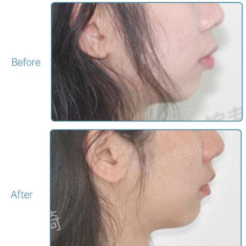 杭州市哪个牙齿矫正好