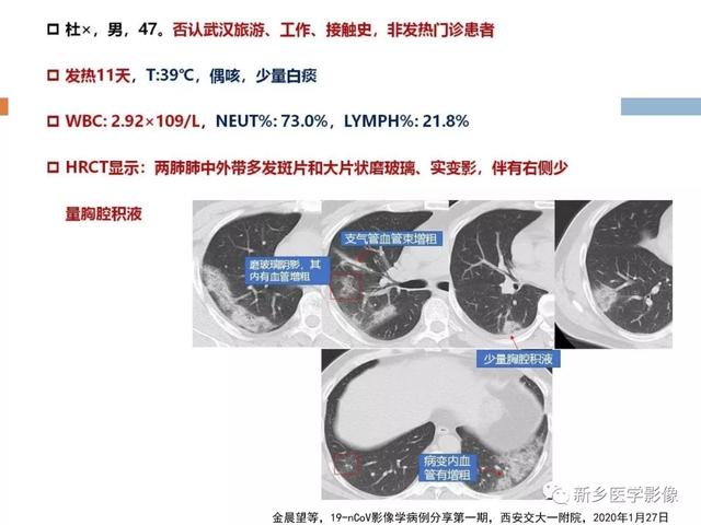 孕妇感染新冠状病毒做ct会导致胎儿畸形吗