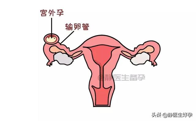 女性宫外孕和男性有很大关系