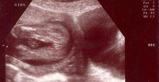 怀孕B超做多了对胎儿有影响吗