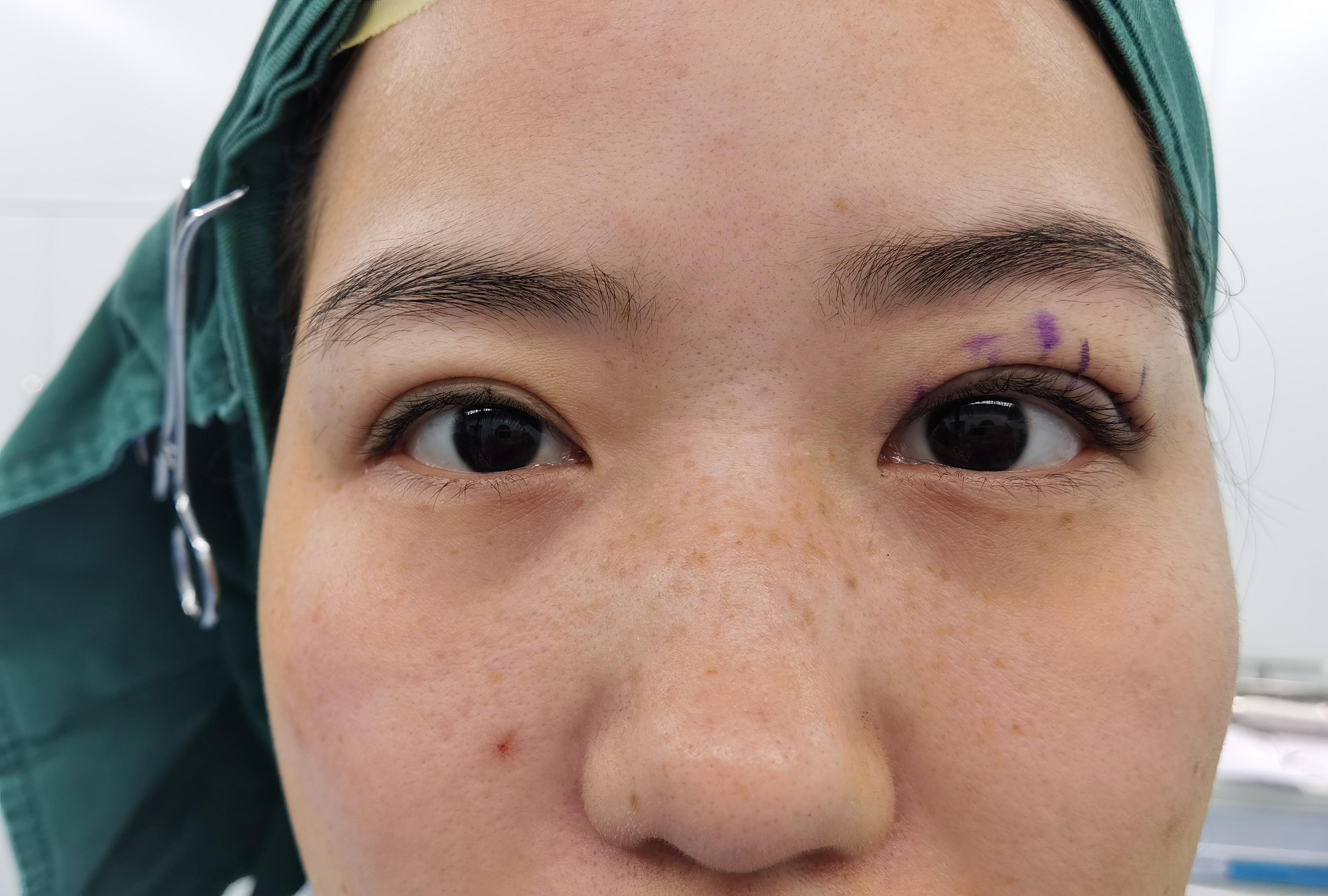 做眼睑下垂修复手术难吗请问河南郑州市上眼睑下垂手术哪家医院做的好