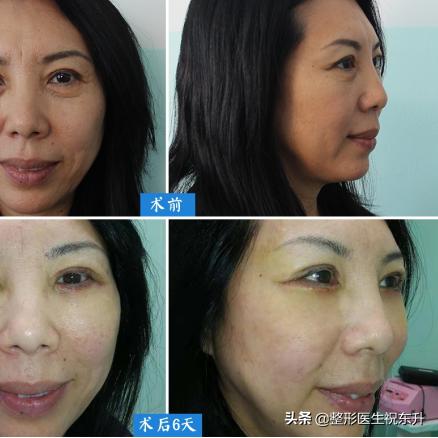 上眼睑下垂做什么手术好的长尾关键词有什么