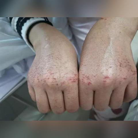 新冠肺炎河南治愈率为什么这么高，已经剩二十几个人了？
