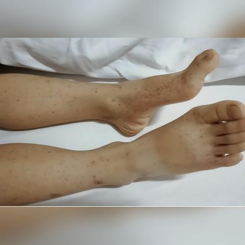 支原体肺炎后遗症？