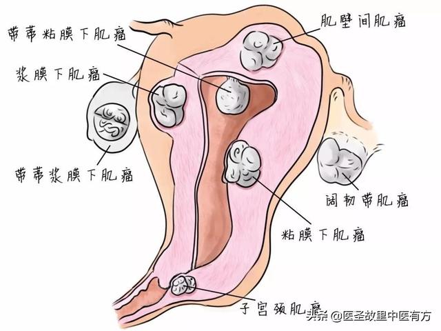 备孕要检查子宫吗