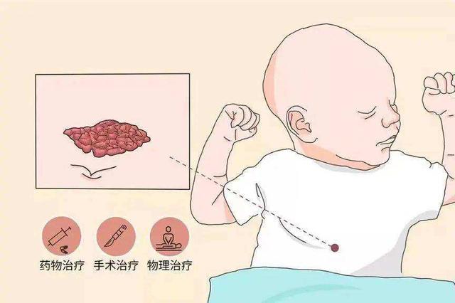 宝宝胎记会自己掉吗
