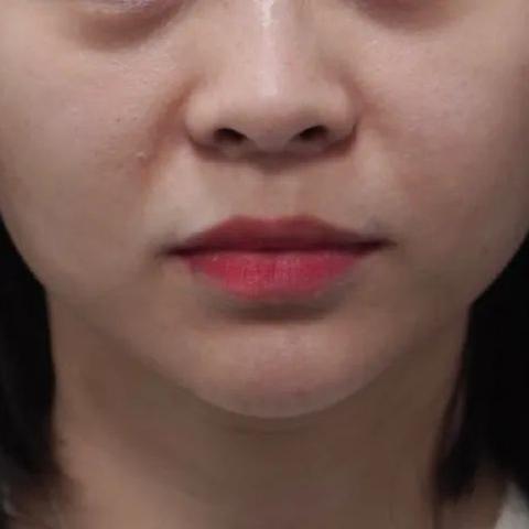 临沂市超声炮的长尾关键词有哪些