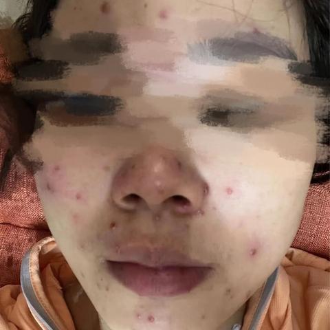 沈阳生殖疱疹医治医院相关长尾关键词有哪些