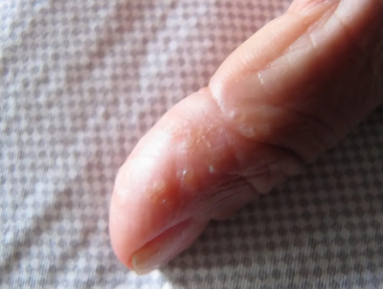 引流条是管吗 引流条是纱布吗