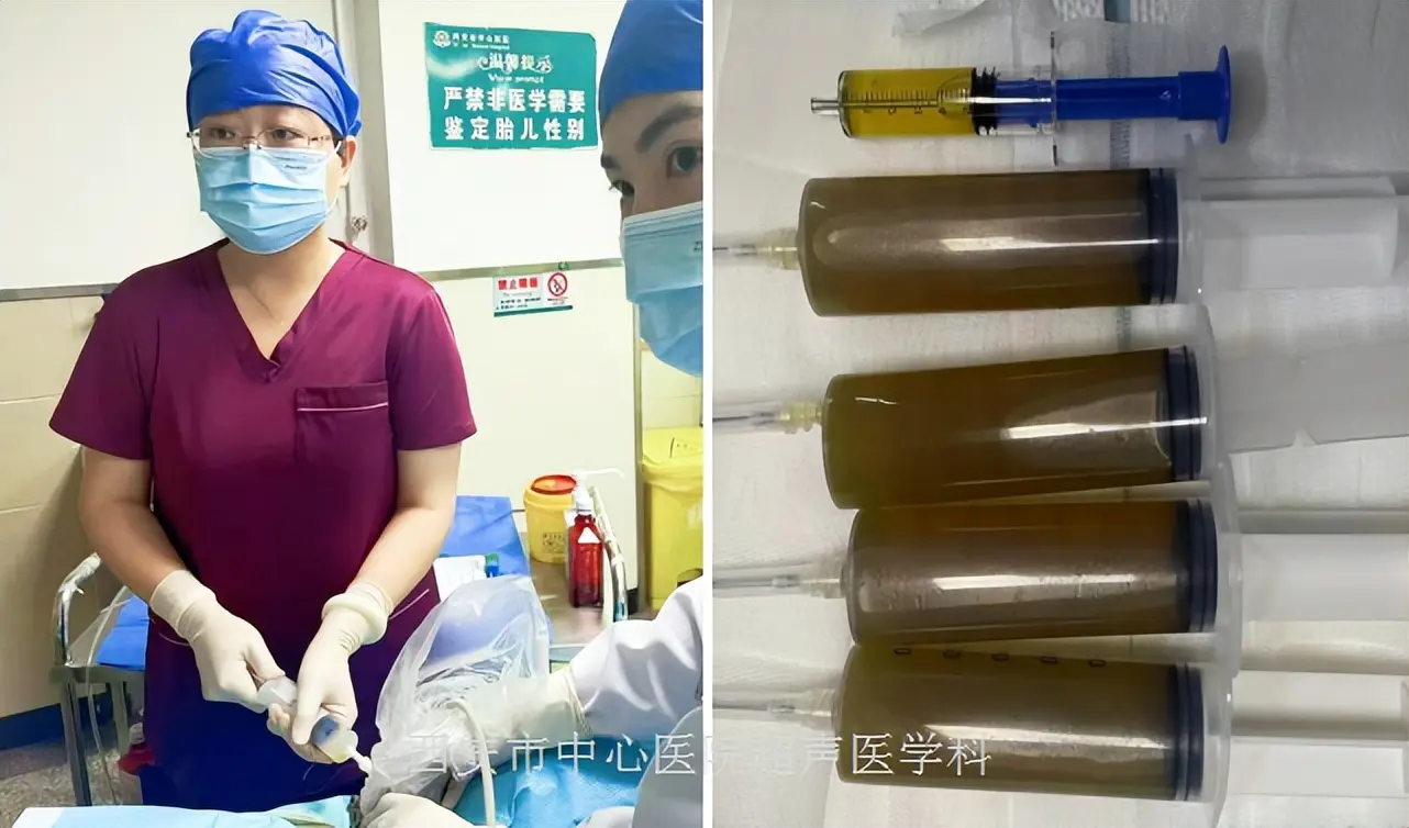 囊肿怎么引流 如何自行引流囊肿