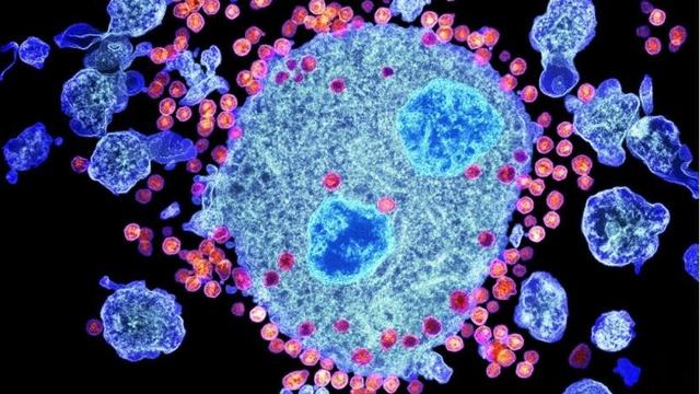 世界上第2例HIV感染者治愈案例