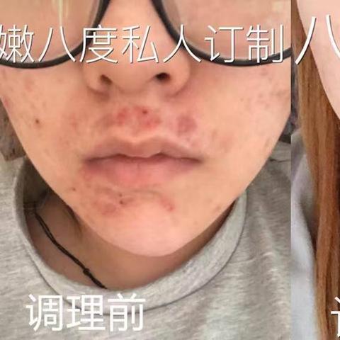 哈尔滨针清闭口相关长尾关键词有哪些