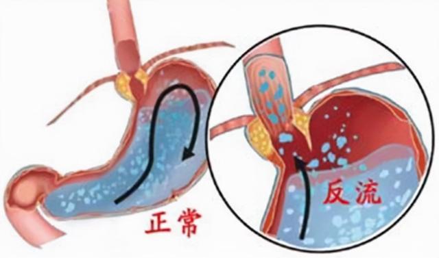 宝宝进食反流怎么办
