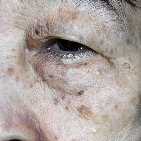 武汉液氮祛斑的长尾关键词有什么