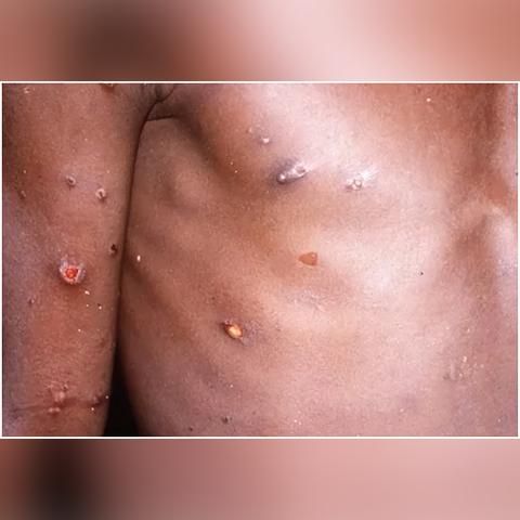 长沙去痘痘相关长尾关键词有哪些