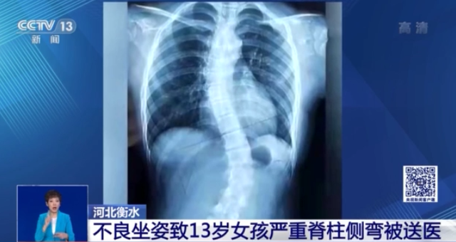 如何预防儿童脊柱侧弯
