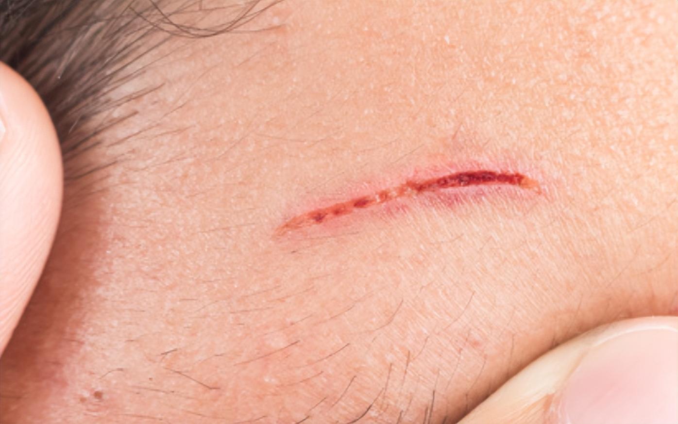 外伤后要缝针，不想留下蜈蚣一样的疤痕？记得这样处理！_伤口_缝线_美容