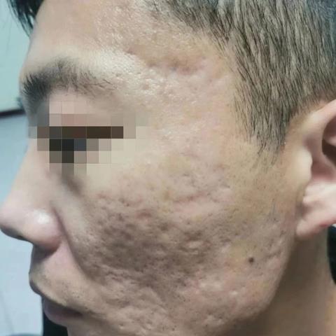 济南市痤疮哪里比较好玩