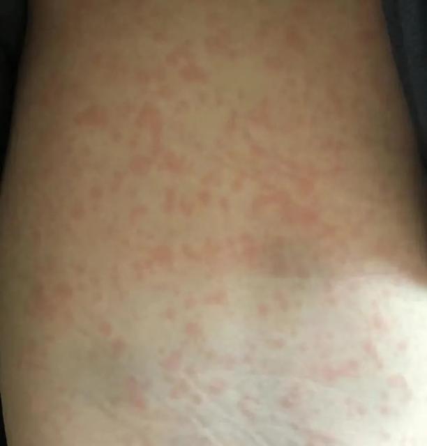 宝宝打完疫苗后发热正常吗