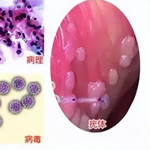 西安市尖锐疣用什么药