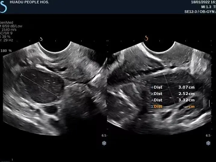 附件囊肿穿刺引流多久 囊肿引流出多久