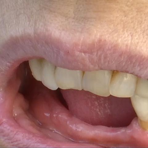 杭州套假牙的相关长尾关键词有哪些