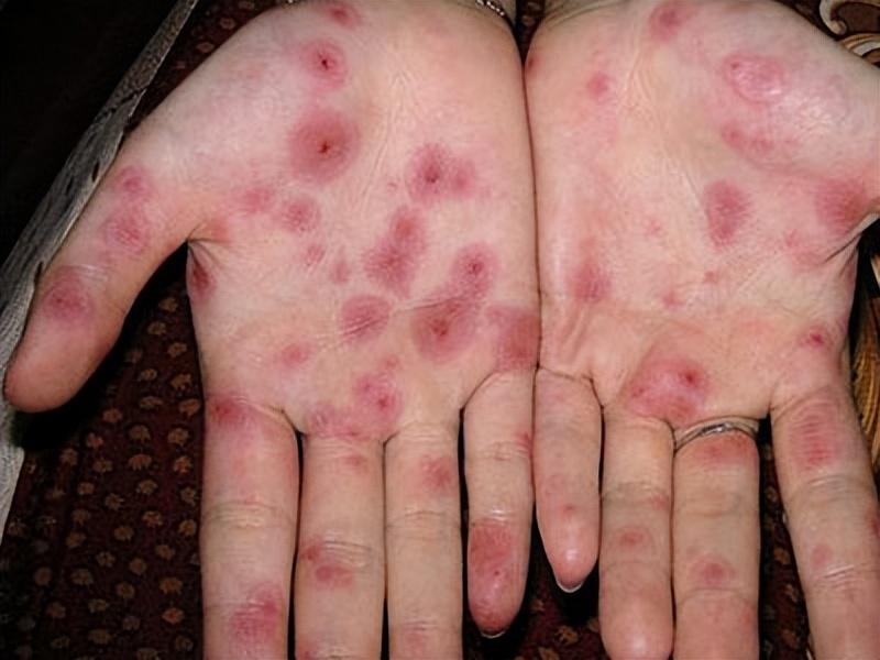 二次感染有什么症状
 ,梅毒二次感染有什么症状