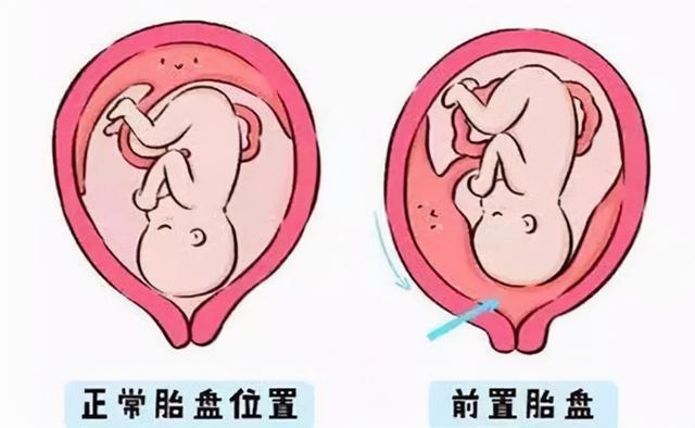 胎盘前壁和胎盘前置有什么区别？注意后者很危险