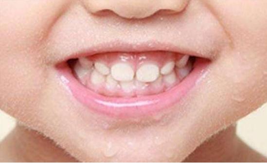孩子不吃糖牙会坏吗