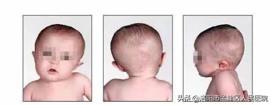 宝宝头总往一边偏是斜颈吗