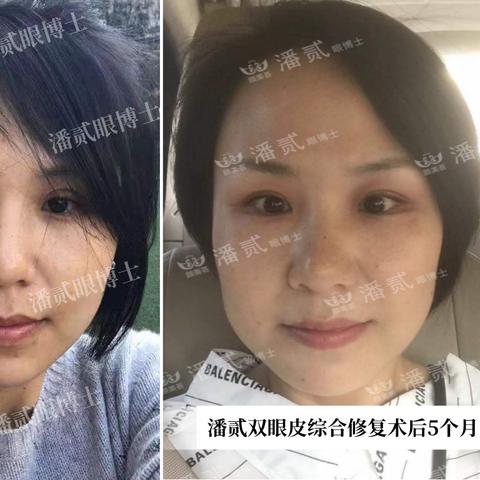 东莞市哪里有割双眼皮的