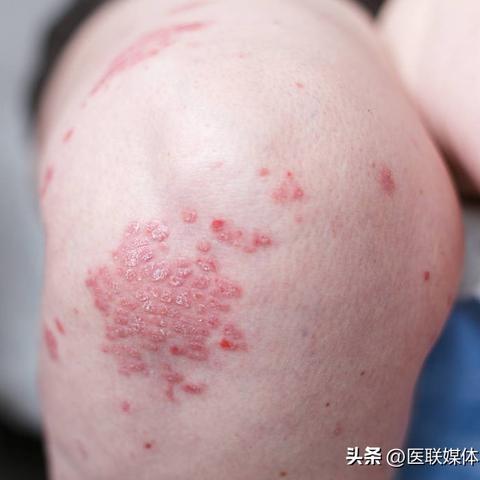 广东佛山市中医院鱼肝油软膏的长尾关键词有哪些