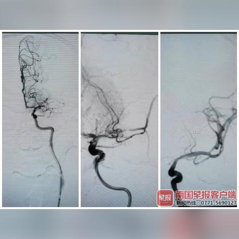 桂林卒中相关长尾关键词有哪些