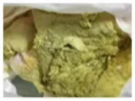 新生儿黄疸怎么治