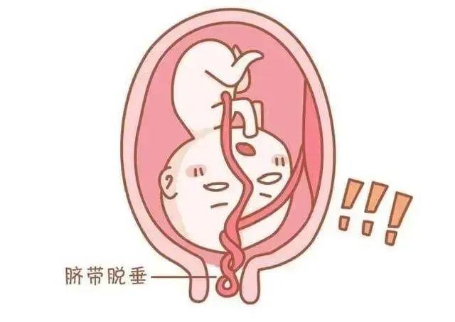胎宝宝脐带短是什么原因