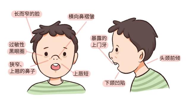 过敏性鼻炎产生的原因是什么
