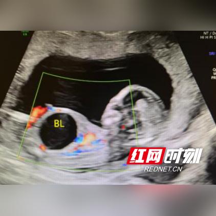 长沙市妇幼保健院约nt挂什么科