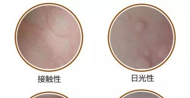 荨麻疹初期症状图片 湿疹长什么样图片
