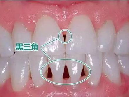 正畸黑三角