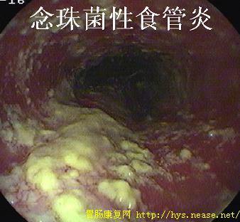 食道有白色的疙瘩