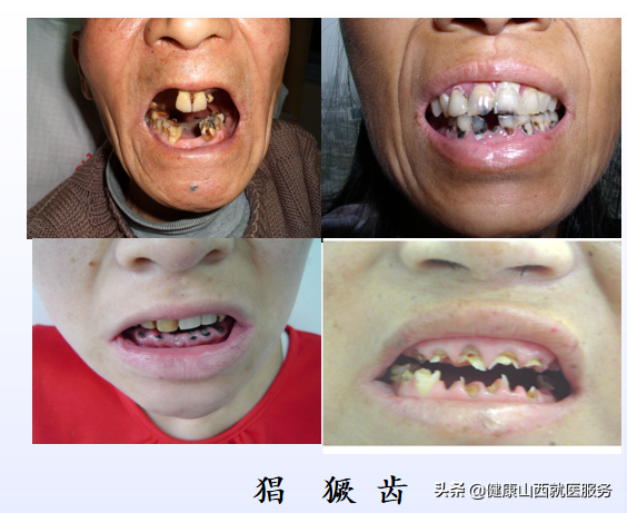 解析梦境，梦到别人牙齿脱落的预兆与深层含义