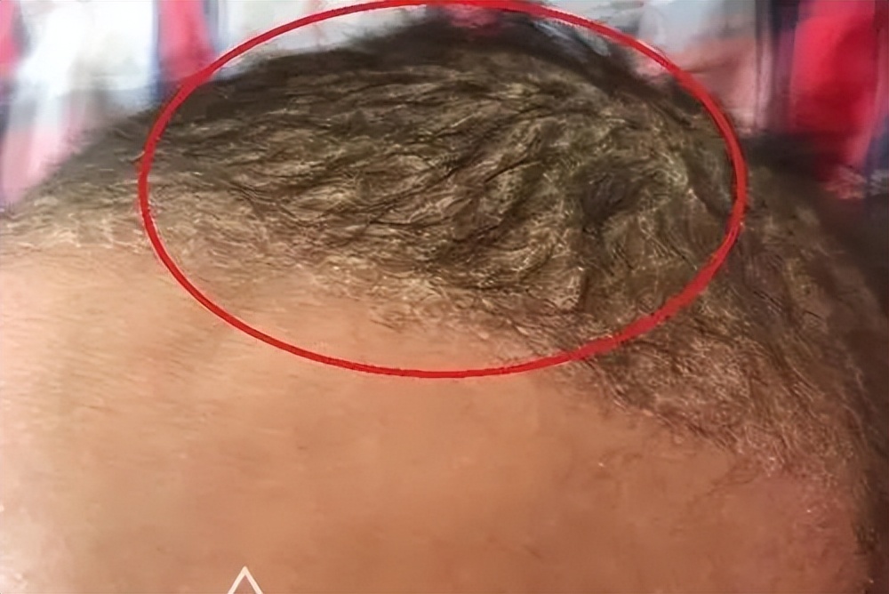 做梦梦到掉了一大把头发，这究竟意味着什么？请求周公解梦