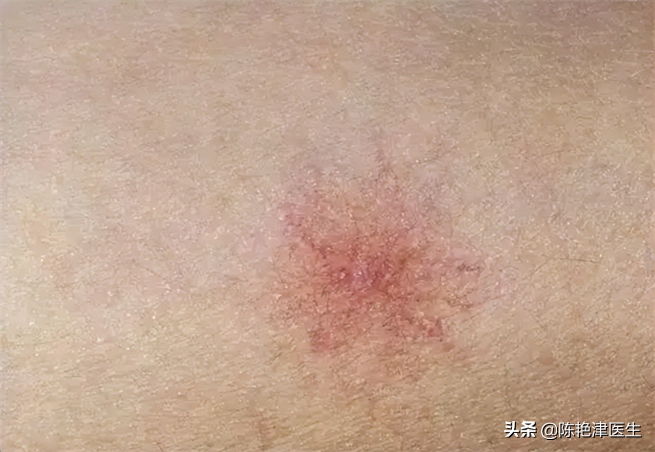 做梦梦到被大蜘蛛咬到脖子了，梦境背后的深层含义与解析